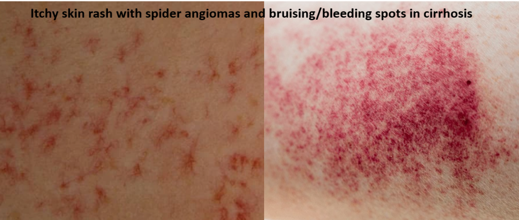 Sirousus Rash Cirrhosis - Understanding and Medical Management