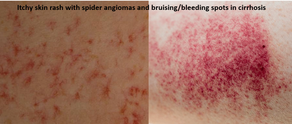 spider angioma