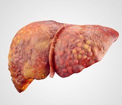 cirrhosis