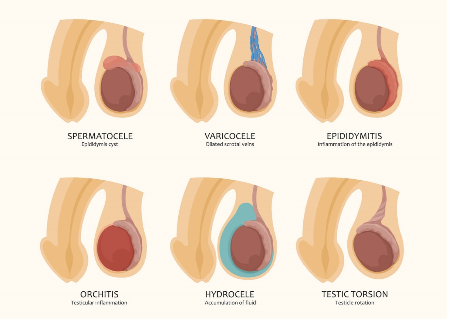 scrotum and testes swelling