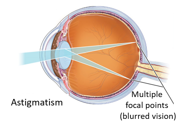 astigmatism