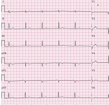 ECG article