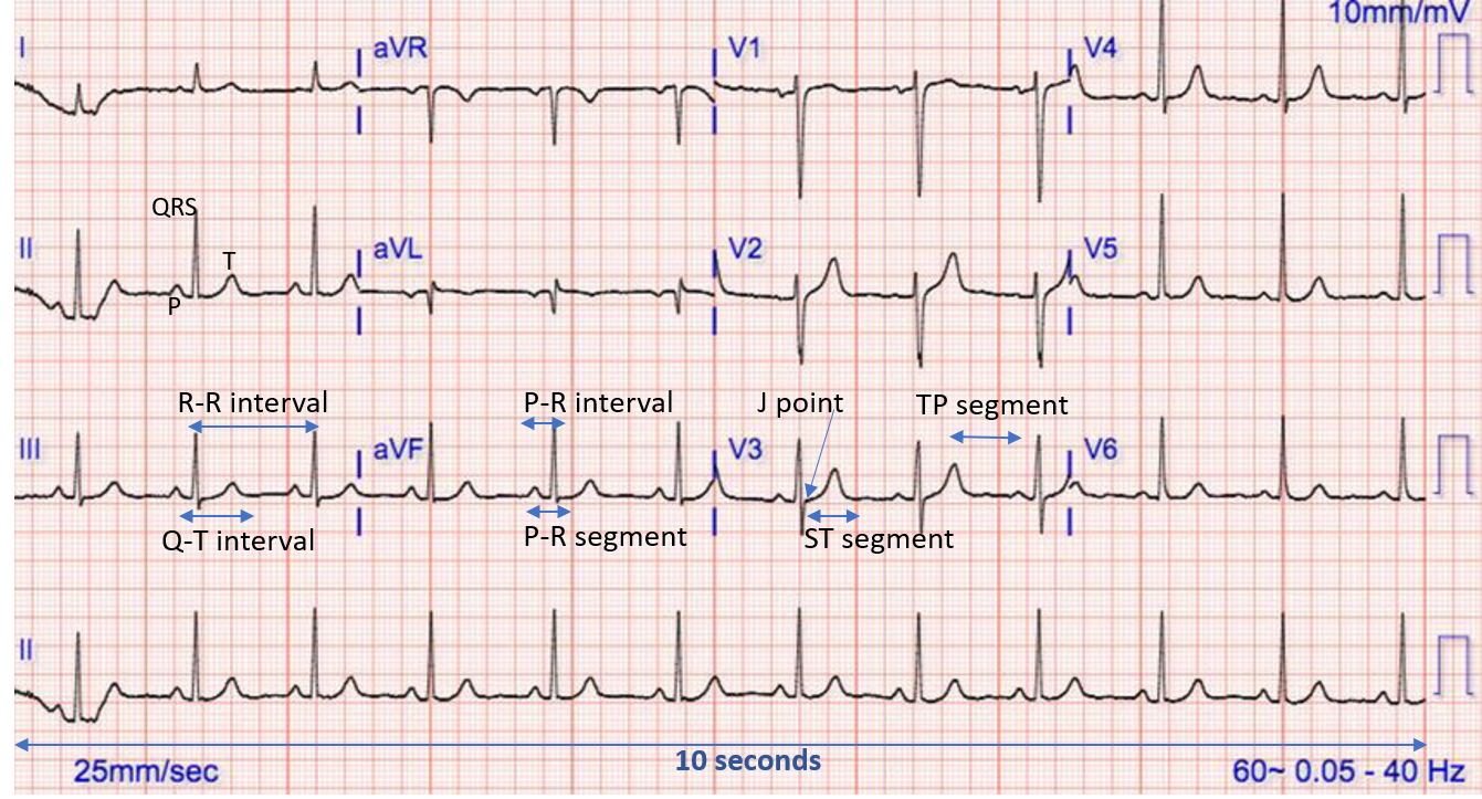 ECG waves and segments