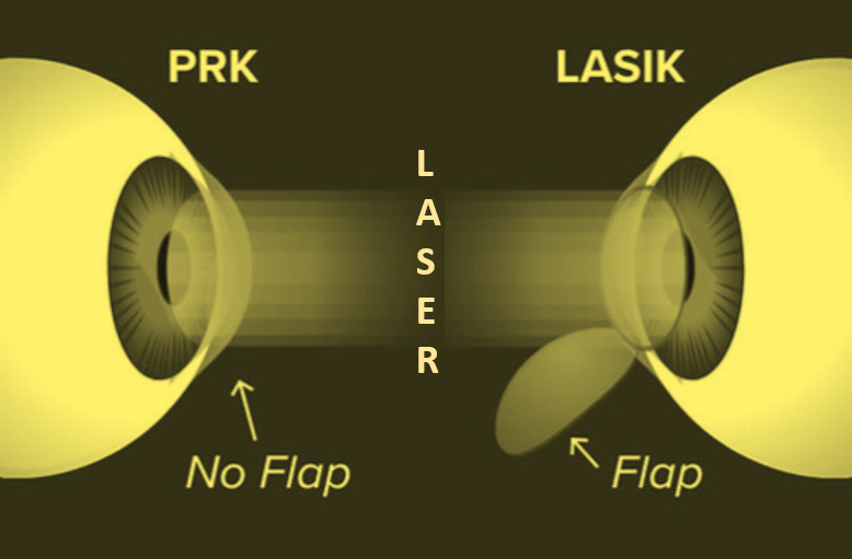 LASIK vs PRK