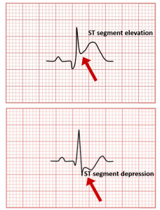 ST segment elevation