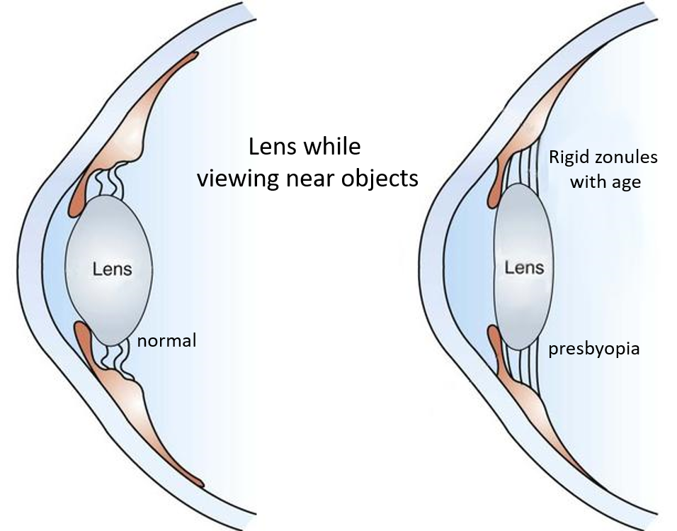 presbyopia