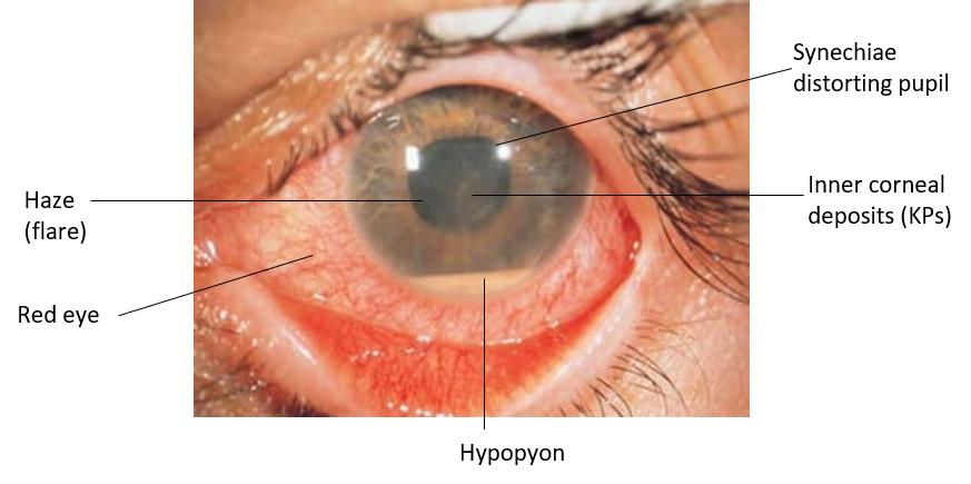 anterior uveitis