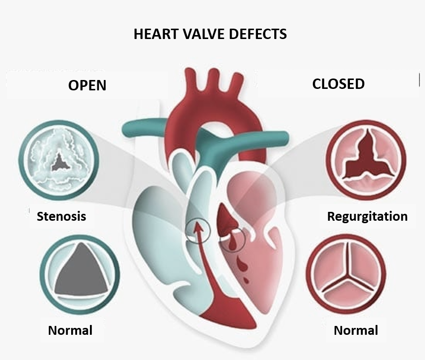 heart valve disease