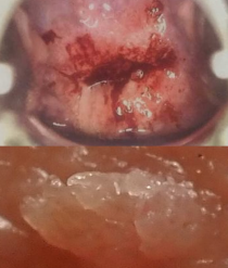Cervical cancer and warts
