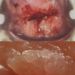 Cervical cancer and warts