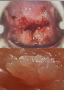 Cervical cancer and warts