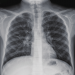 bronchiectasis