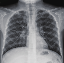 bronchiectasis