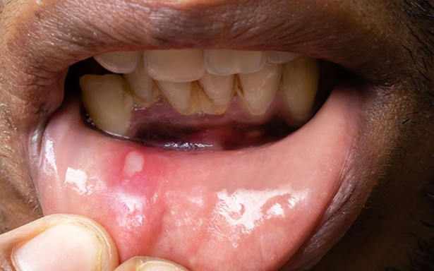 canker sore