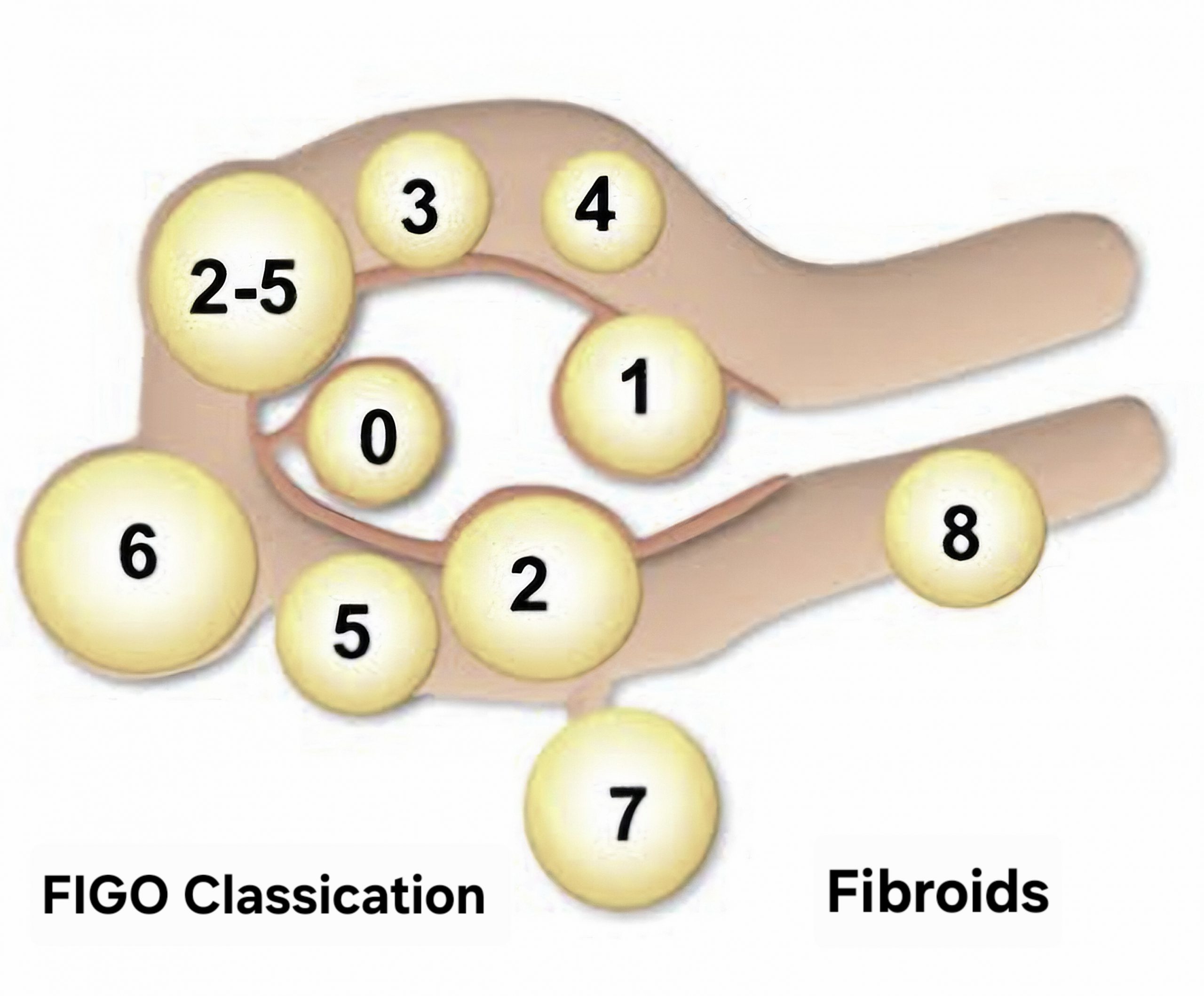 FIGO classification