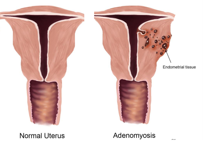 adenomyosis