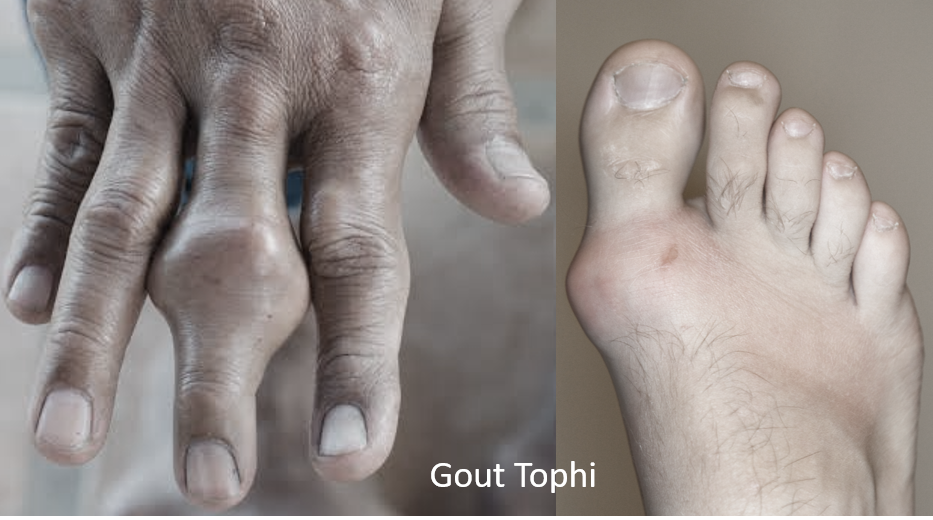 Uric acid tophi
