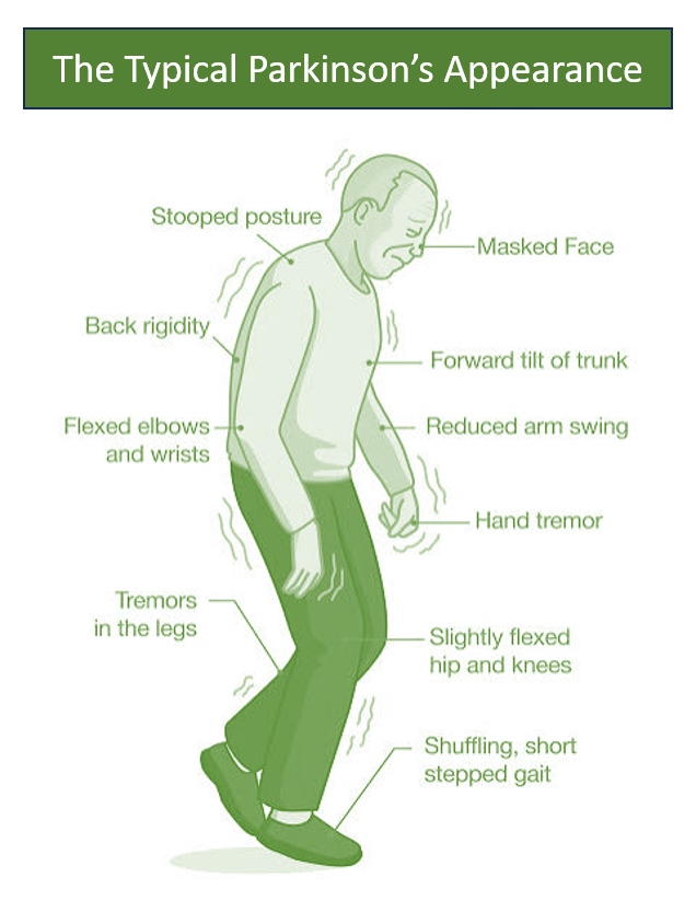 Parkinson's disease